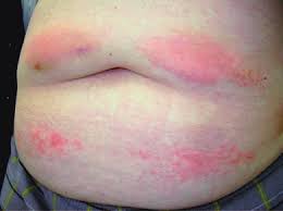 Heparin-Induced Thrombocytopenia Treatment Market Size, Share, Industry, Trends 2025-2033
